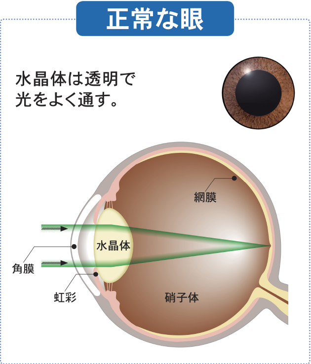 正常な眼