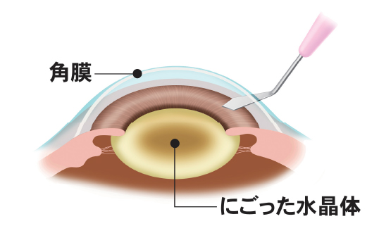 眼内レンズを入れる穴を作る