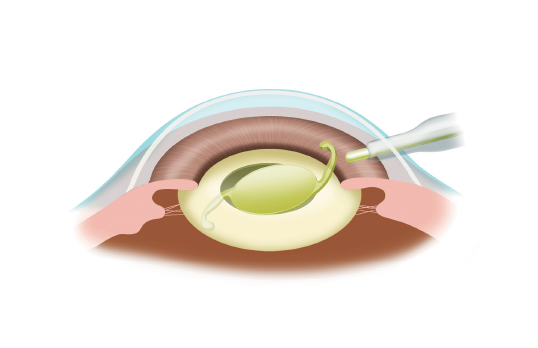 眼内レンズを入れる