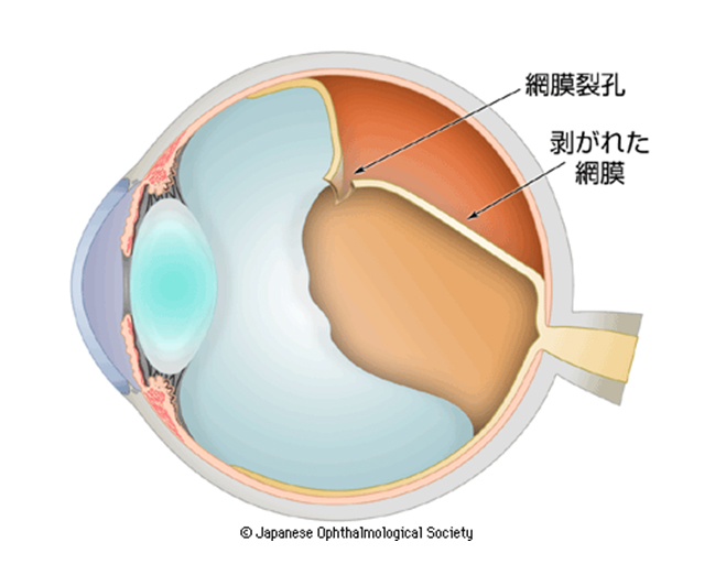 裂孔原性網膜剥離