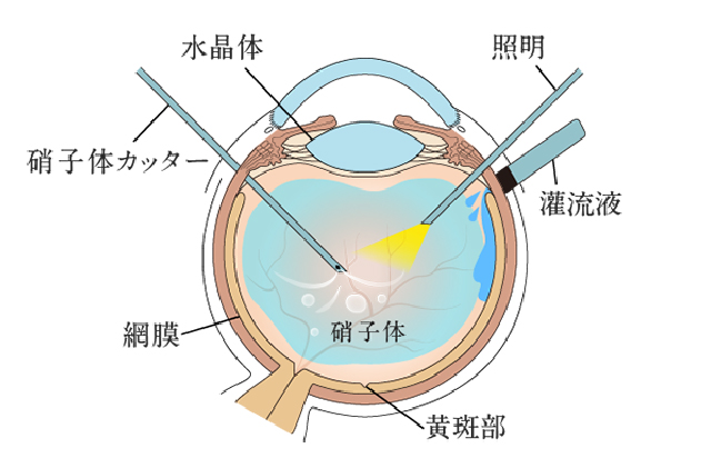 硝子体手術